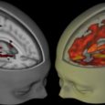 A team of scientists have visualised the human brain under the influence of LSD, lysergic acid diethylamide, for the first time ever in a recent […]